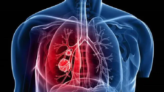 Cáncer pulmón COVID-19. Foto: Difusión