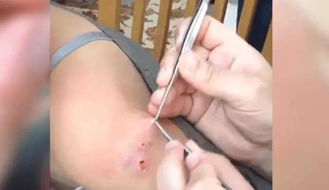 Facebook viral: espeluznantes criaturas son extraídas del brazo de una mujer que dejan en shock a doctor [VIDEO]