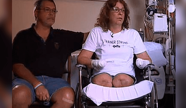 Mujer pierde brazos y piernas luego de que su mascota le lamiera una herida [VIDEO]
