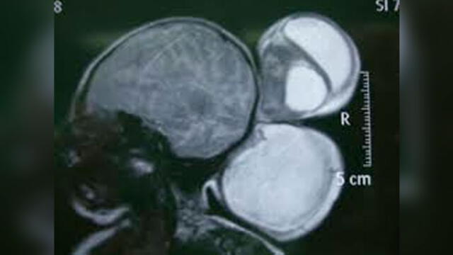 Anomalía denominada encefalocele. Se produce cuando el tubo neural no se cierra completamente durante el embarazo. Foto referencial.