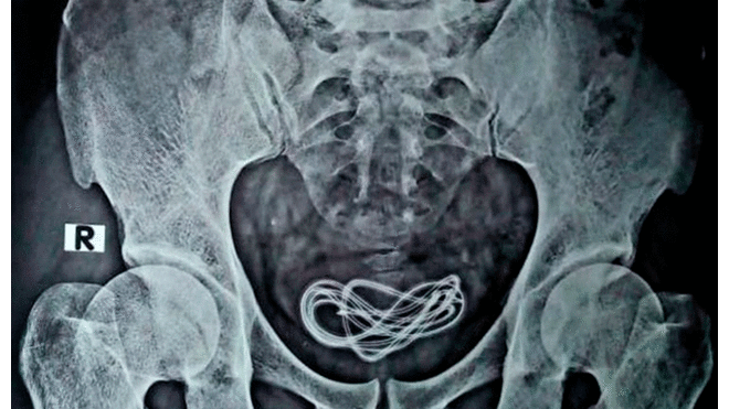 Los médicos encontraron el cable USB enroscado en la vejiga del hombre. Foto: Dr. Walliul Islam / CNN.