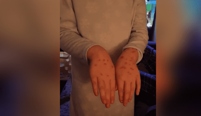 Facebook viral: niña usa increíble “truco” para enfermarse de varicela, pero todo le sale mal [FOTOS] 