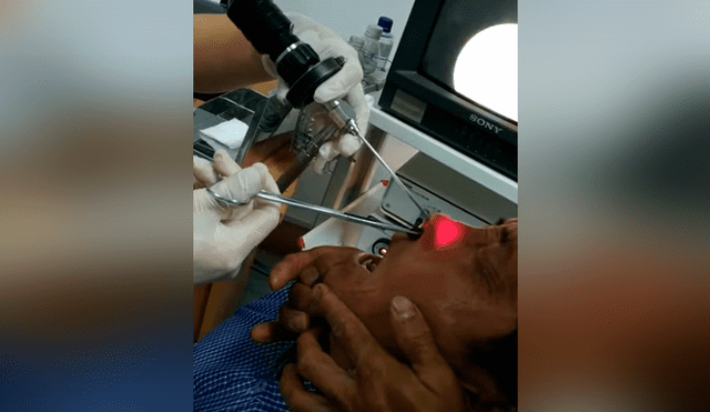 YouTube viral: graban a médico retirando extraña criatura de la nariz de un hombre [VIDEO]
