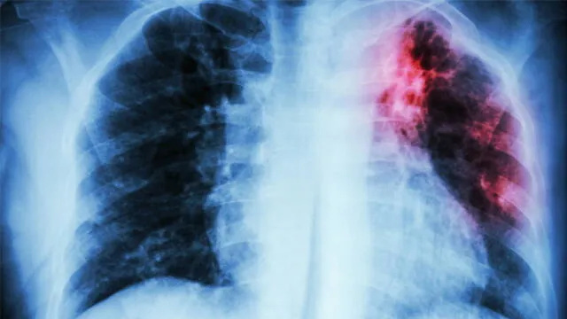 EsSalud: fibrosis pulmonar es una enfermedad incurable y es mortal si no se detecta a tiempo