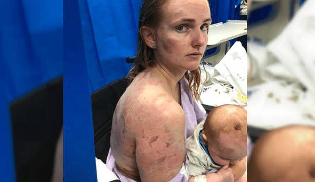 Madre australiana sufrió severos moretones al proteger a su bebé de una tormenta de granizo