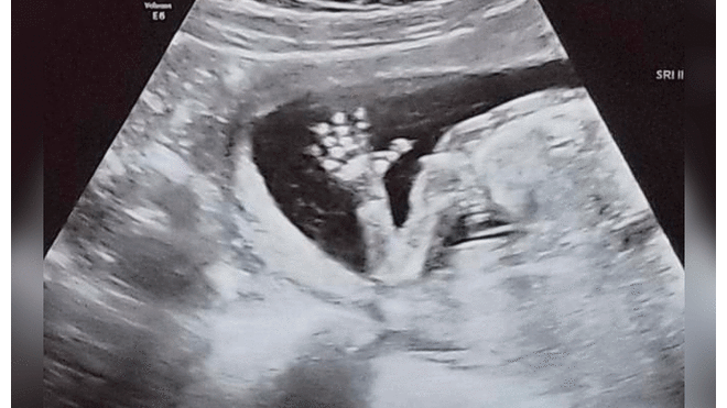 Mujer embarazada se hace ecografía y descubre que tiene dos vaginas y dos úteros