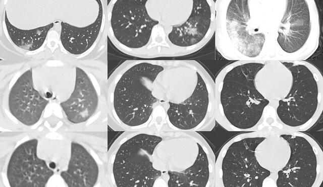 Algunas tomografías computarizadas de niños con coronavirus. Foto: Pediatric Pulmonology