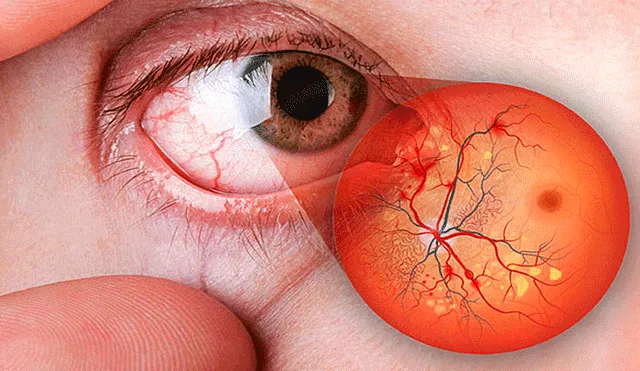 Conoce las complicaciones más frecuentes en la retina