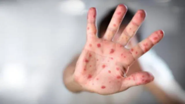 Crece el brote de sarampión en México, la ‘otra epidemia’ que ya tiene vacunación
