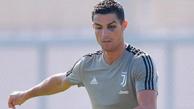 Cristiano Ronaldo apareció con el ojo morado en los entrenamientos de Juventus