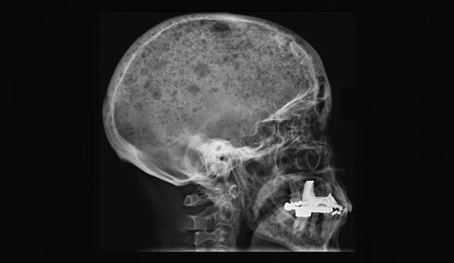 Las personas que padecen cáncer de médula ósea suelen presentar perforaciones en el cráneo que les generan mucho dolor | Foto: Dra. Jennie Roberts, Radiopaedia.org