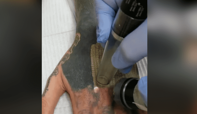 Facebook viral: joven decide quitarse tatuaje del brazo, sin imaginar el terrible resultado que tendría