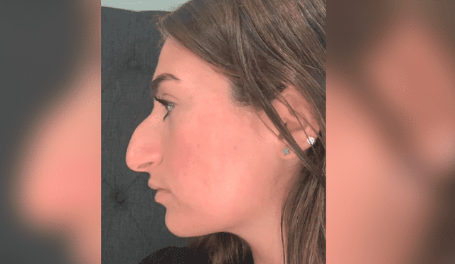 La joven mostró el antes y el después de su operación en la nariz y ahora luce totalmente diferente. Foto: captura
