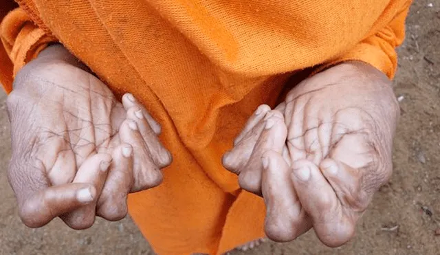 Mujer con 31 dedos en manos y pies rompe récord, pero sus vecinos la llaman ‘bruja’ [VIDEO]