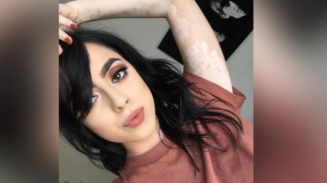 Instagram: Sufre de vitiligo, pero sus fotos son tendencia [FOTOS]