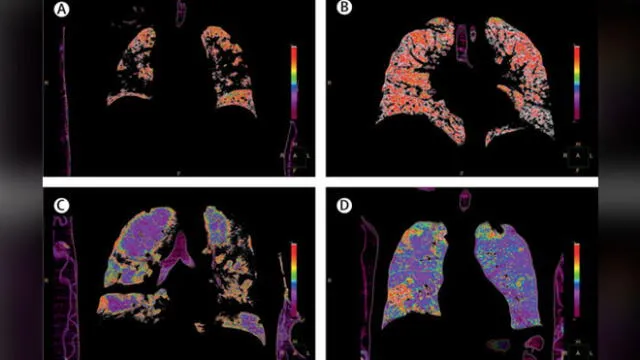 La investigación se centró en el "doble daño" e los pulmones. Imágenes: The Lancet / Grasseelli, et al.