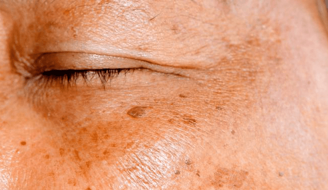 ¿Manchas oscuras en la piel? 5 tratamientos que sí funcionan
