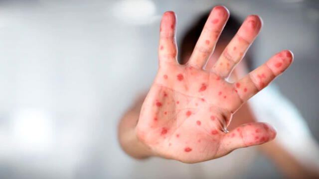 Epidemia de sarampión en Nueva York se enfrenta con vacunación obligatoria