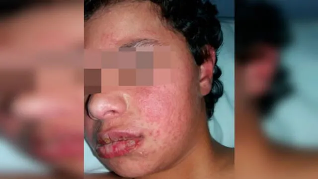 Niño pierde la piel y uñas porque le recetaron una dosis excesiva de un medicamento