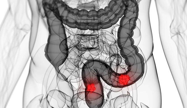 Los factores de riesgo del cáncer de intestino son la obesidad, el tabaquismo y el sedentarismo | Foto: Difusión