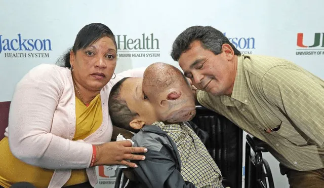 Emanuel, niño cubano con tumor en el rostro, falleció tras operación 