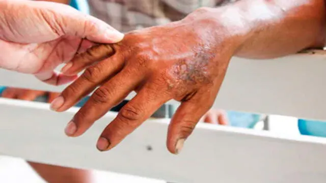 En Cuba diagnostican al menos 200 casos de lepra por año, según cifras de la OPS