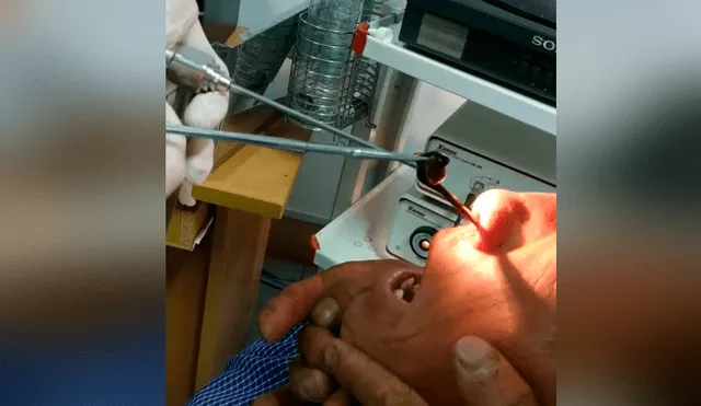YouTube viral: graban a médico retirando extraña criatura de la nariz de un hombre [VIDEO]