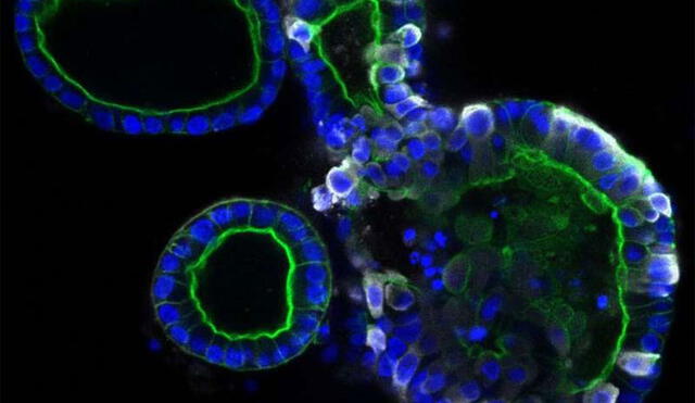 Organoides intestinales. El derecho está infectado por el SARS-CoV-2 (color blanco). Crédito: Instituto Hubrecht.