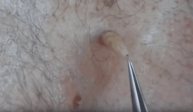YouTube viral: joven va al médico por roncha en su espalda y le hacen espeluznante hallazgo [VIDEO]