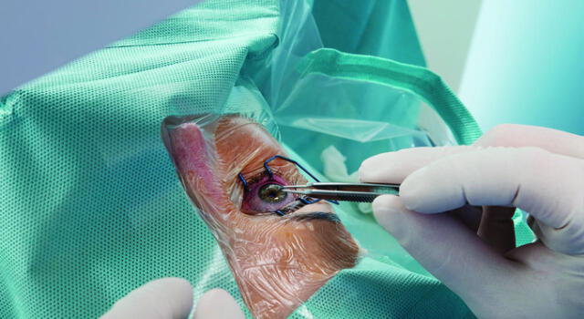 Cirugía de catarata y glaucoma