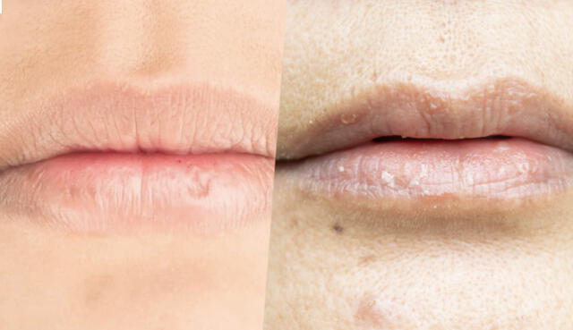 Conoce los factores que podrían llevar a que los labios se puedan irritar y hasta quebrar. Foto: Composición La República