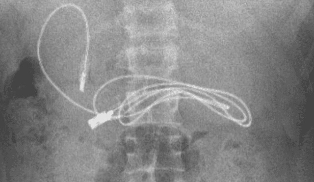 Radiografía que mostró el cable USB dentro del estómago del adolescente. Foto: Instagram/@prof.dr.yasardogan