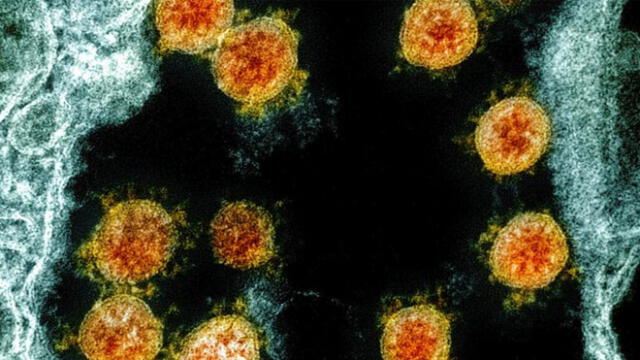 Pacientes con COVID-19 sufren aparición de diabetes. Imagen: Partículas del nuevo coronavirus en un paciente / NIAID.