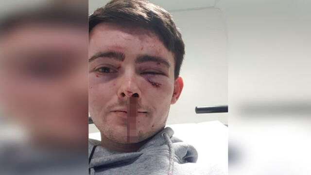 Hombre queda con lesiones en los ojos tras recibir brutal agresión de ladrones [FOTOS]