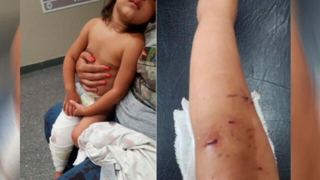 Niña de dos años sufre salvaje ataque de perro pitbull y recibe 40 puntos en su pierna [VIDEO]