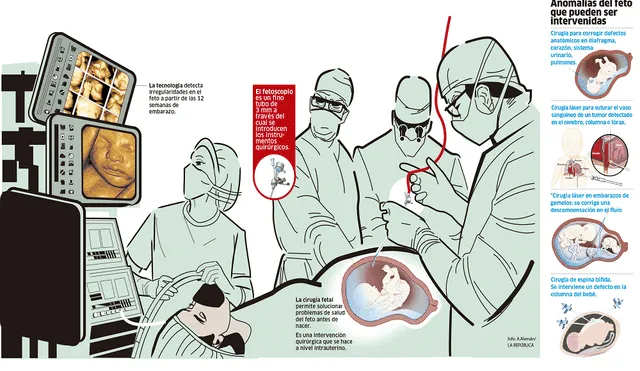 Cirugía intrauterina, operar antes de nacer