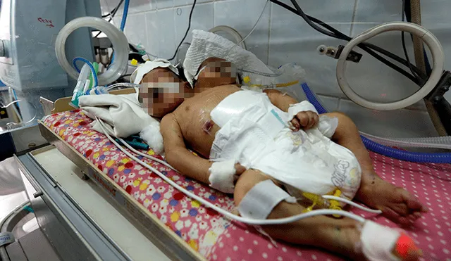 Bebés siameses mueren en Yemen al no recibir tratamiento [VIDEO]