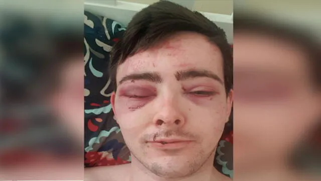 Hombre queda con lesiones en los ojos tras recibir brutal agresión de ladrones [FOTOS]