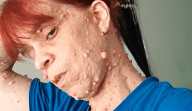Mujer cubierta de más de 2.000 tumores revela que es abusada por extraños en la calle [FOTOS]