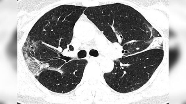 Tomografías muestran el daño que causa el coronavirus en los pulmones [FOTOS]
