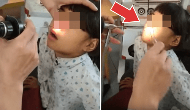 Facebook viral: médico extrae extraña criatura de las fosas nasales de una niña [VIDEO]
