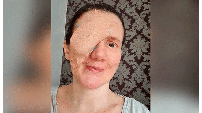 Mujer se desgarra la córnea al secarse la cara y médicos le extirpan su ojo para salvarla [FOTOS]