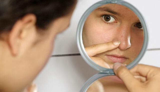 Salud: ¿Cómo combatir el acné en jóvenes y adultos?
