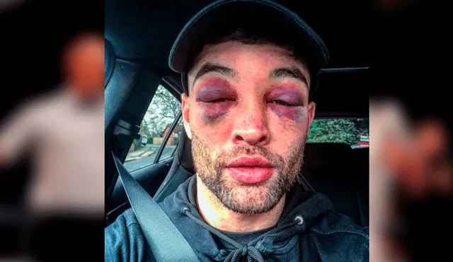 Boxeador queda irreconocible tras brutal paliza que recibió durante un combate [FOTOS]
