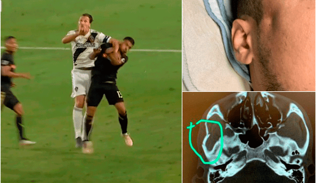 Zlatan Ibrahimovic le provocó una fractura de cráneo a un rival en la MLS. | Foto: @AmroAbdelAziz / ESPN
