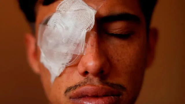 Víctimas de trauma ocular exigen a gobierno de Piñera una reparación efectiva