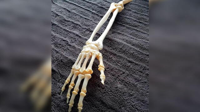Hombre conserva los huesos disecados del brazo que le amputaron [FOTOS]