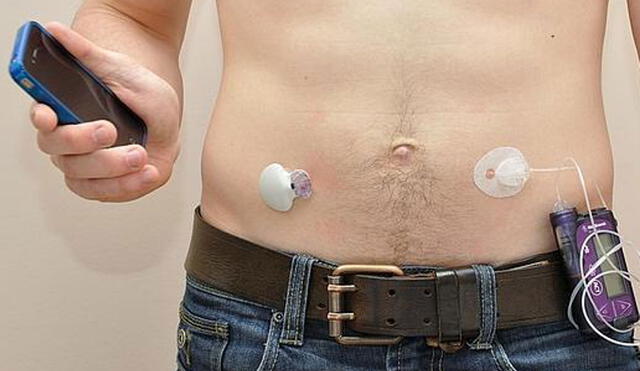 El páncreas artificial consta de un sensor bajo la piel que mide los niveles de glucosa en la sangre y una bomba que administra insulina según se requiera. Foto: referencial / ABC