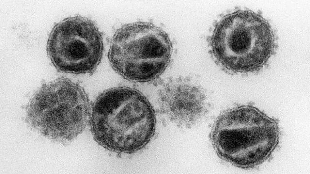 Imagen del virus VIH, que causa el sida. Foto: Instituto Robert Koch.