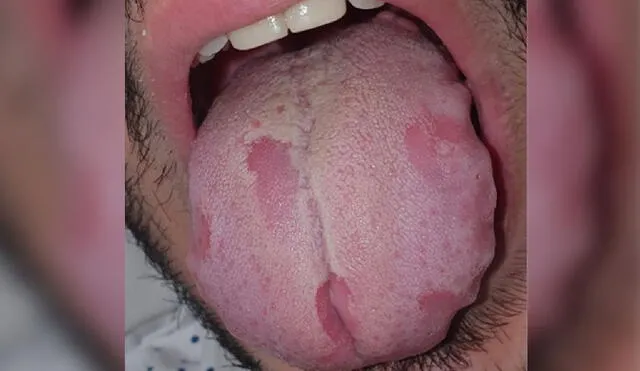 Algunos pacientes presentaban lesiones en la lengua. Foto: Nuno-Gonzáles et al